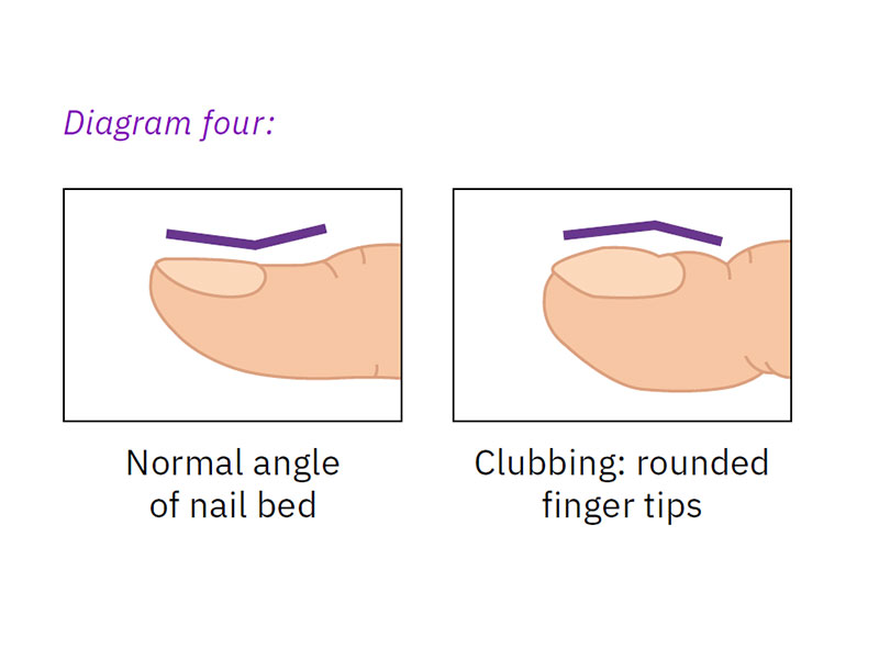 Clubbing Fingers Symptoms